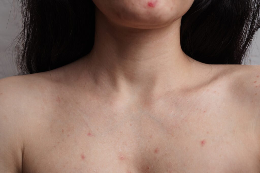 Close-up of the skin of the face and body of a woman with acne and other dermatological problems