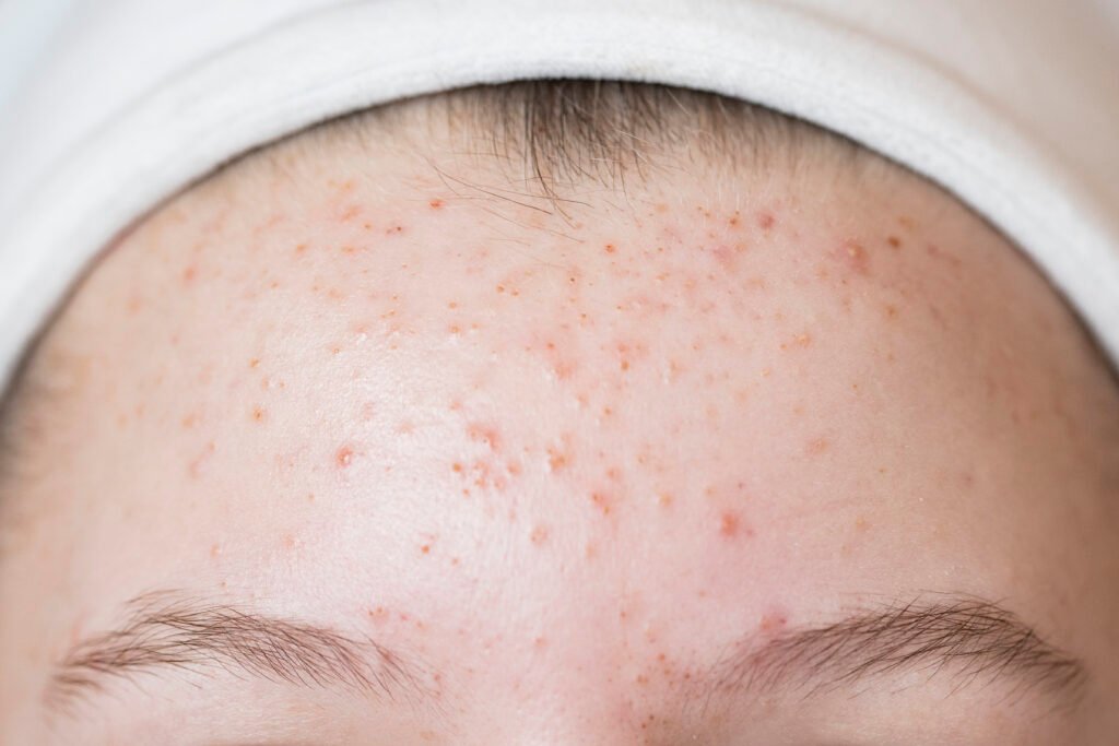 Teen girl with acne problem. Skin care concept with copy space